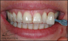 teethwhite1