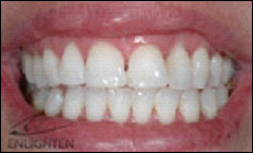 teethwhite2